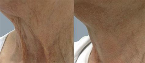 buffalo aesthetics|Fibroblast Skin Tightening in Buffalo, NY 